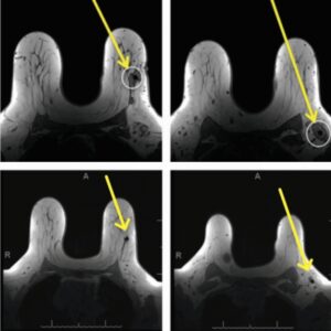 Merit Scout Radar Localisation nssignificant MRI Artefact