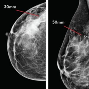 Merit Scout Radar Localisation Mammographic Upright Views Prior to Surgery