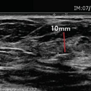 Merit Scout Radar Localisation Meausrement to Tumour in supine position differ