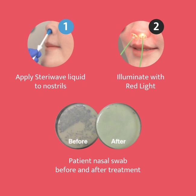 Steriwave Nasal Photodisinfection – How to use