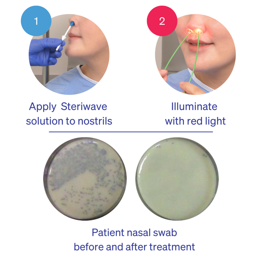 Steriwave Nasal Photodisinfection - Image 4